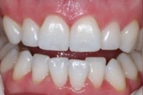 Case1-After tooth whitening