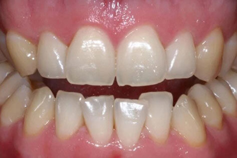 Case1-After tooth whitening