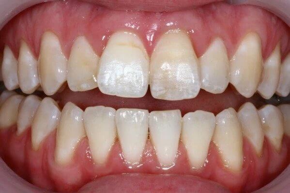 Case1-After tooth whitening