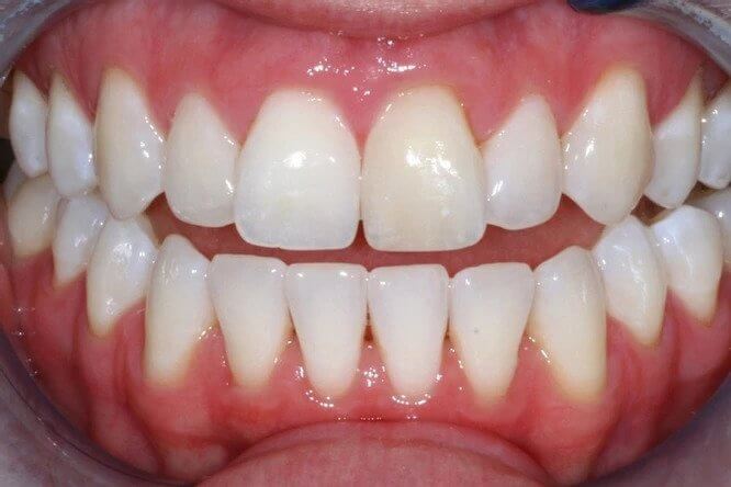 Case1-After tooth whitening