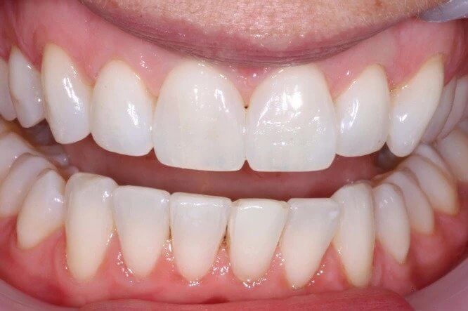 Case1-After tooth whitening