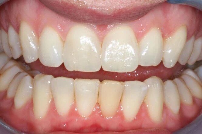 Case1-After tooth whitening