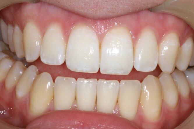 Case1-After tooth whitening
