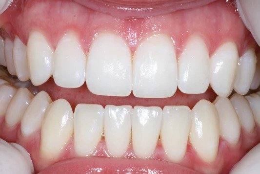 Case1-After tooth whitening
