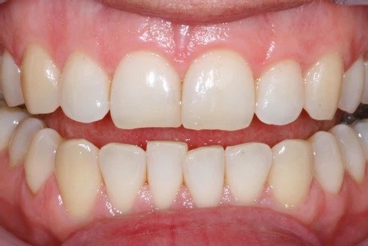Case1-After tooth whitening