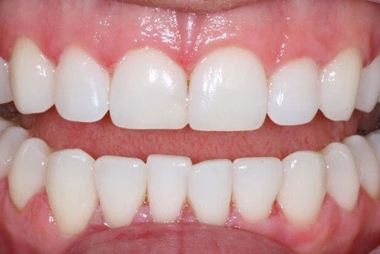 Case1-After tooth whitening