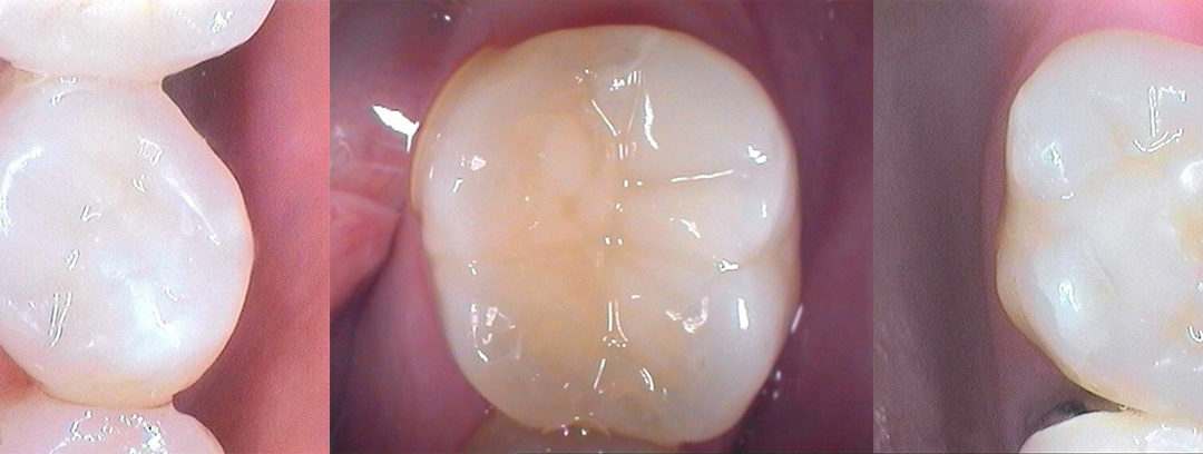 Tooth Coloured Fillings