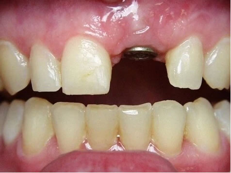 Teeth Image Teeth Image