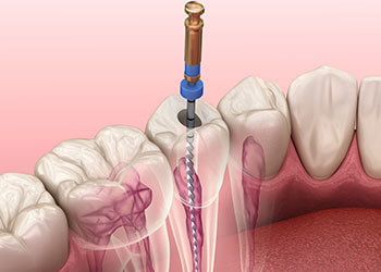 How-a-Root-Canal-Procedure-Works differences veneers vs crowns woden